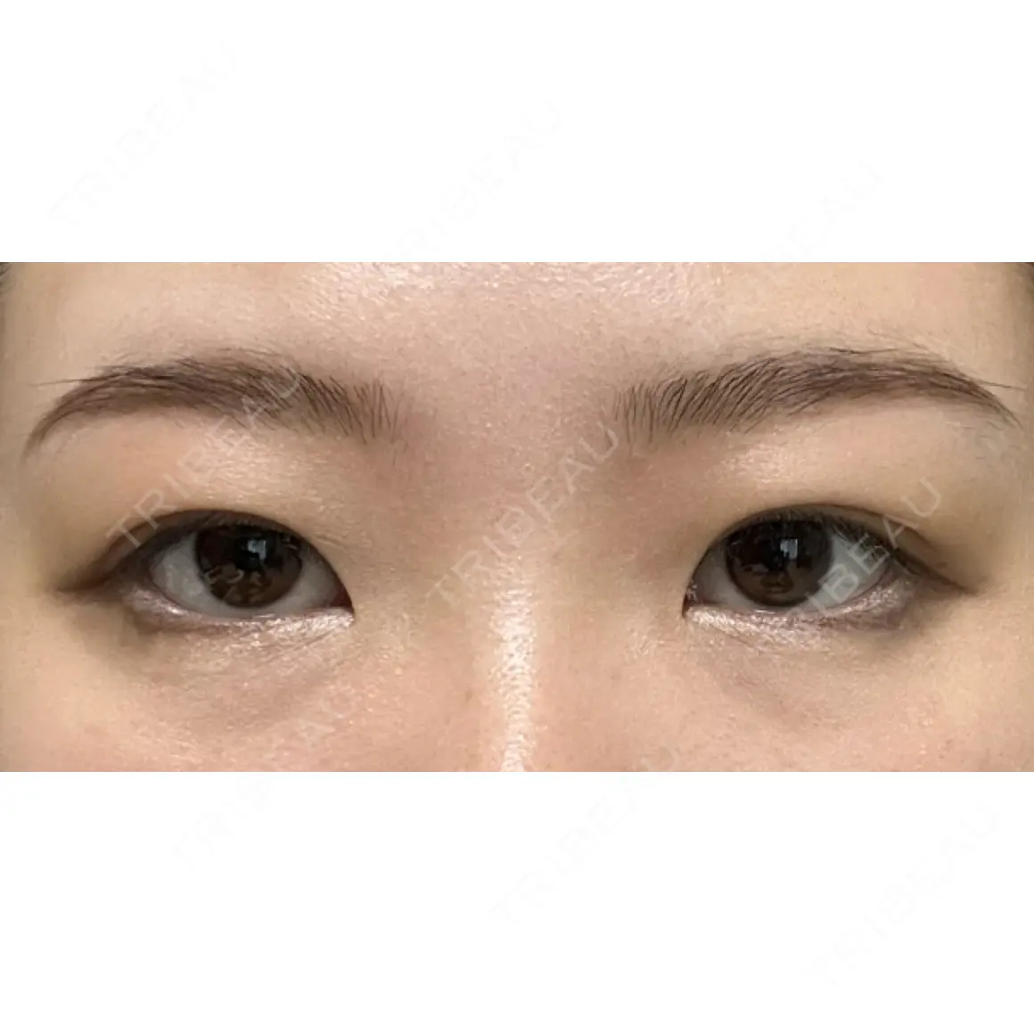 二重切開 オアシス美容外科 AFTER