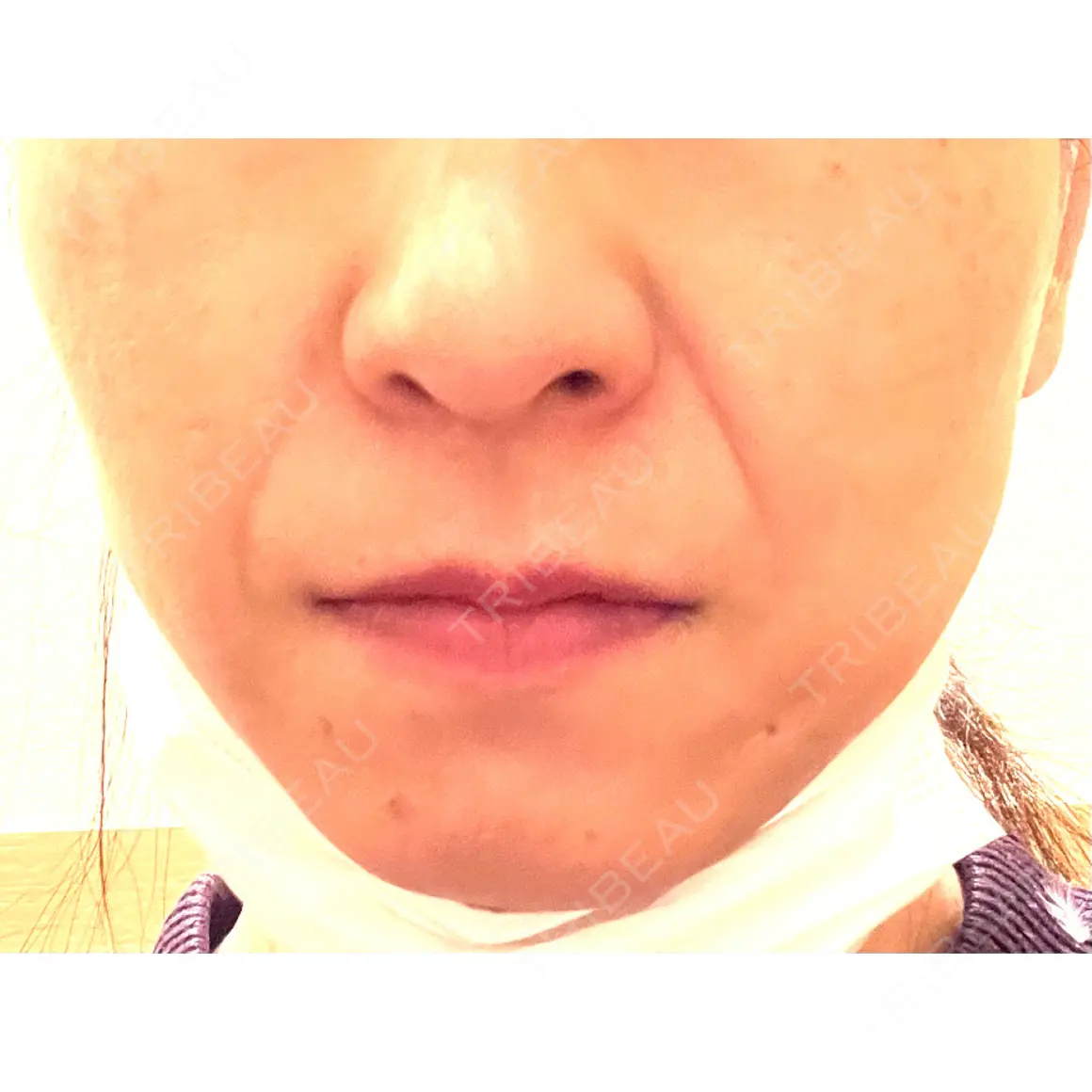 PRP皮膚再生療法 聖心美容クリニック 札幌院 AFTER