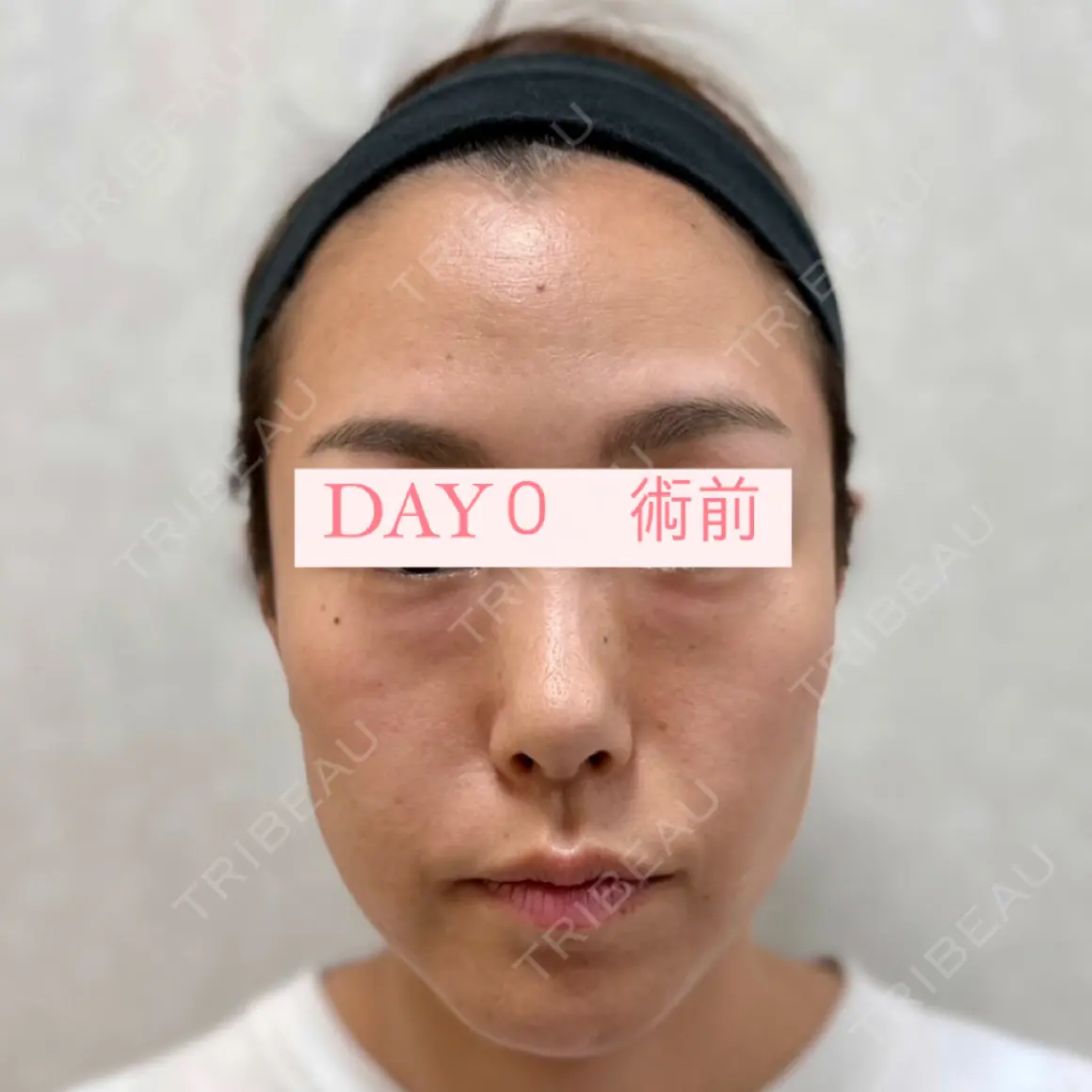 クマ治療 / 脂肪吸引（顔） / 下まぶたたるみ取り / 下まぶたの脂肪取り / 脂肪注入（肌） / ジョールファット除去 / あご下筋肉縛り Wi Clinic（ウィ クリニック） 大宮院 AFTER