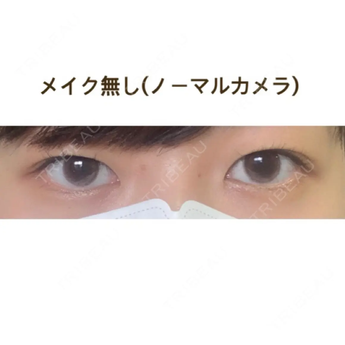 二重埋没 ルラ美容クリニック 高田馬場院 AFTER