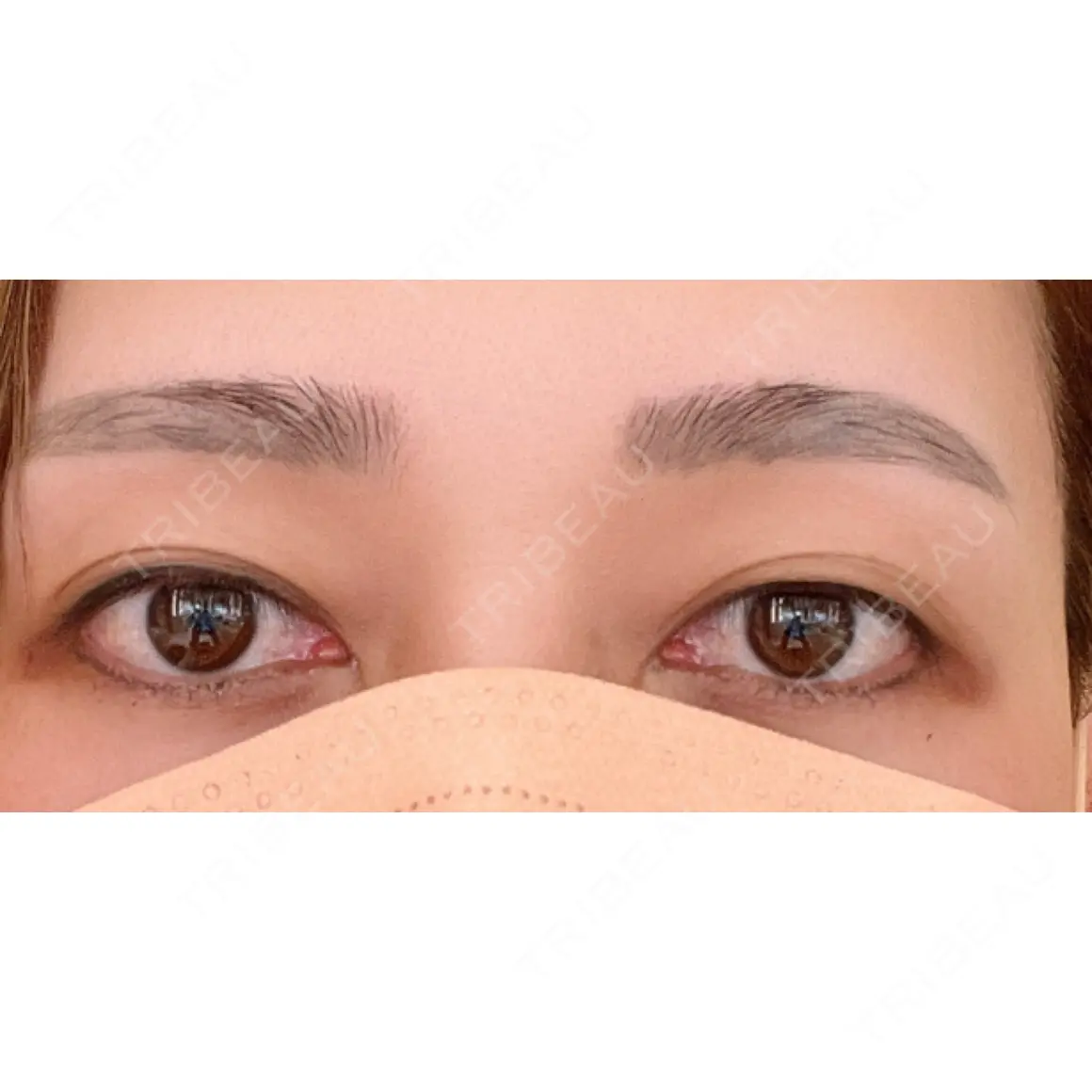 二重埋没 HAAB×DREAM BEAUTY CLINIC 大阪梅田院 AFTER