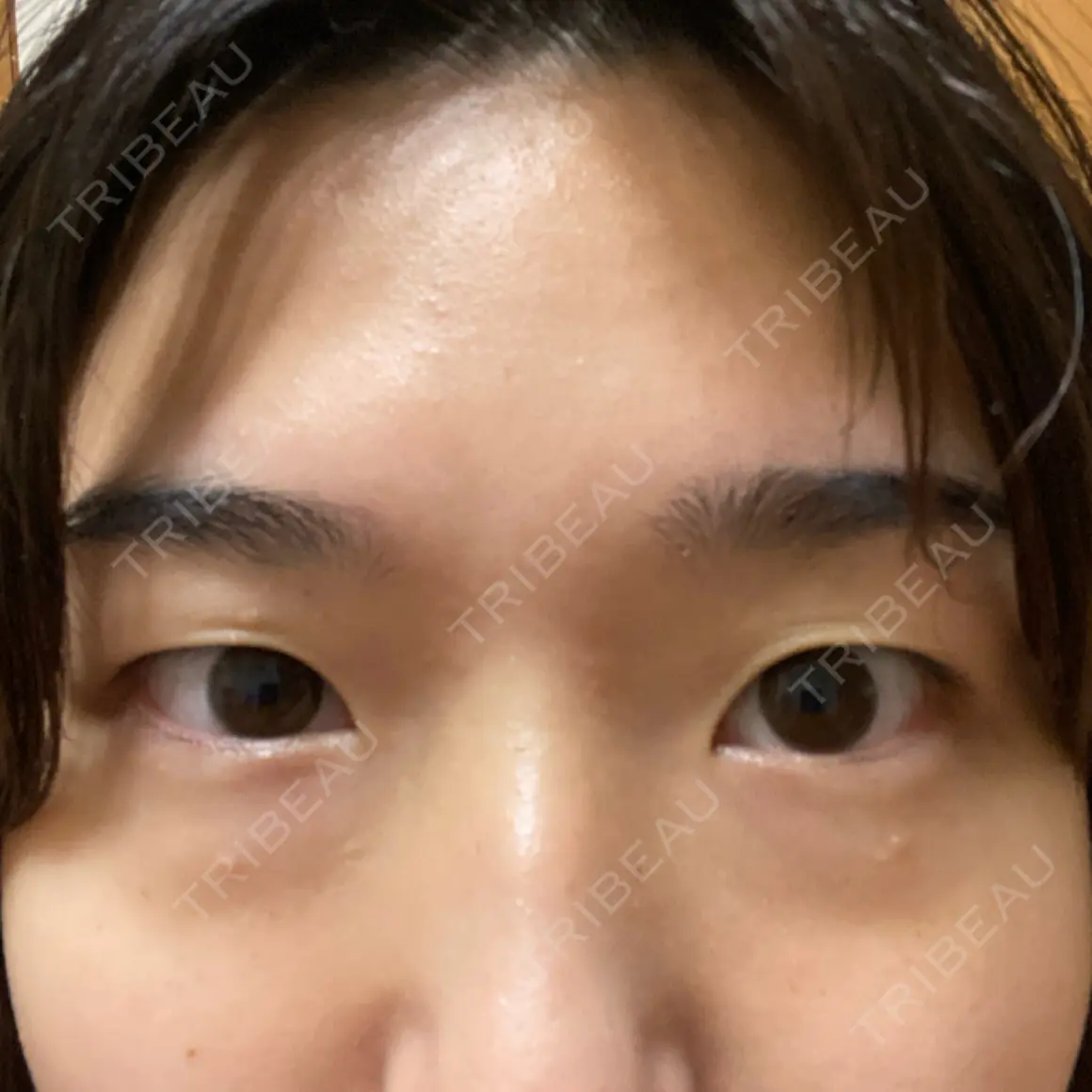 二重埋没 / ボトックス（エラ・小顔） HAAB×DREAM BEAUTY CLINIC 大阪梅田院 AFTER