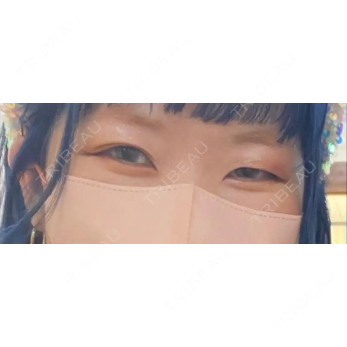 二重埋没 ALMOND CLINIC AFTER