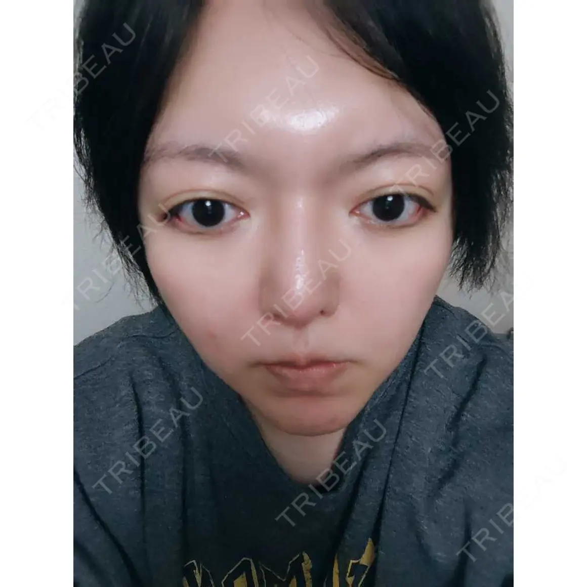 二重切開 品川美容外科 新宿院（※品川スキンクリニック提携） AFTER