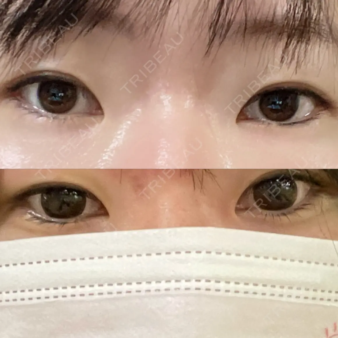 二重切開 / 目頭切開 聖心美容クリニック 札幌院 AFTER