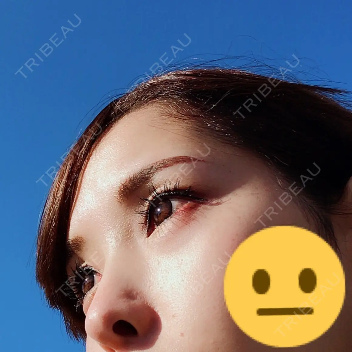 ヒアルロン酸注入（涙袋） / その他（目元） 渋谷美容外科クリニック 池袋院 AFTER