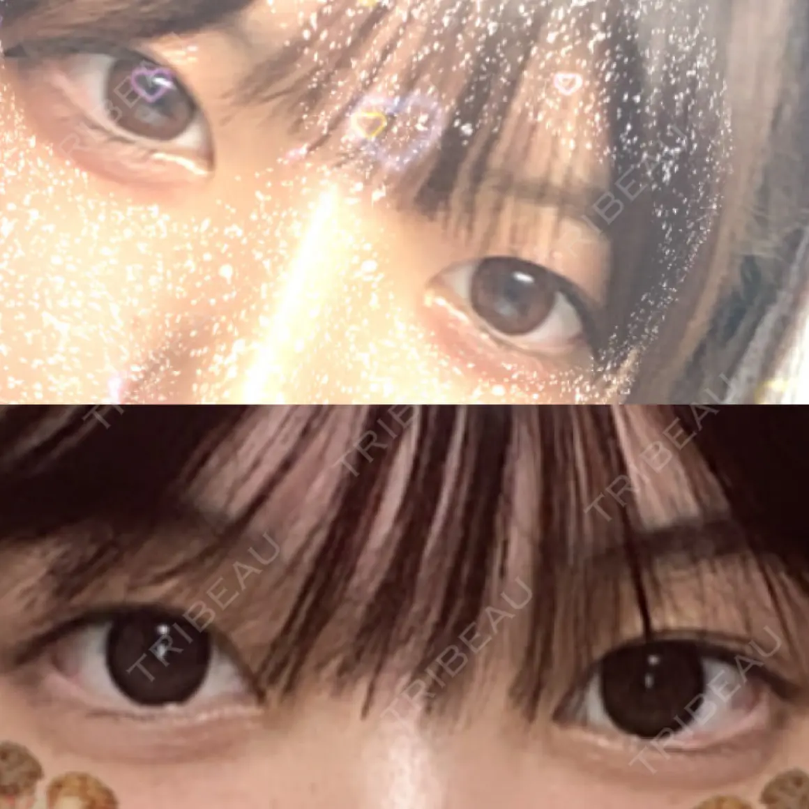 二重埋没 ルラ美容クリニック 名古屋本院 AFTER