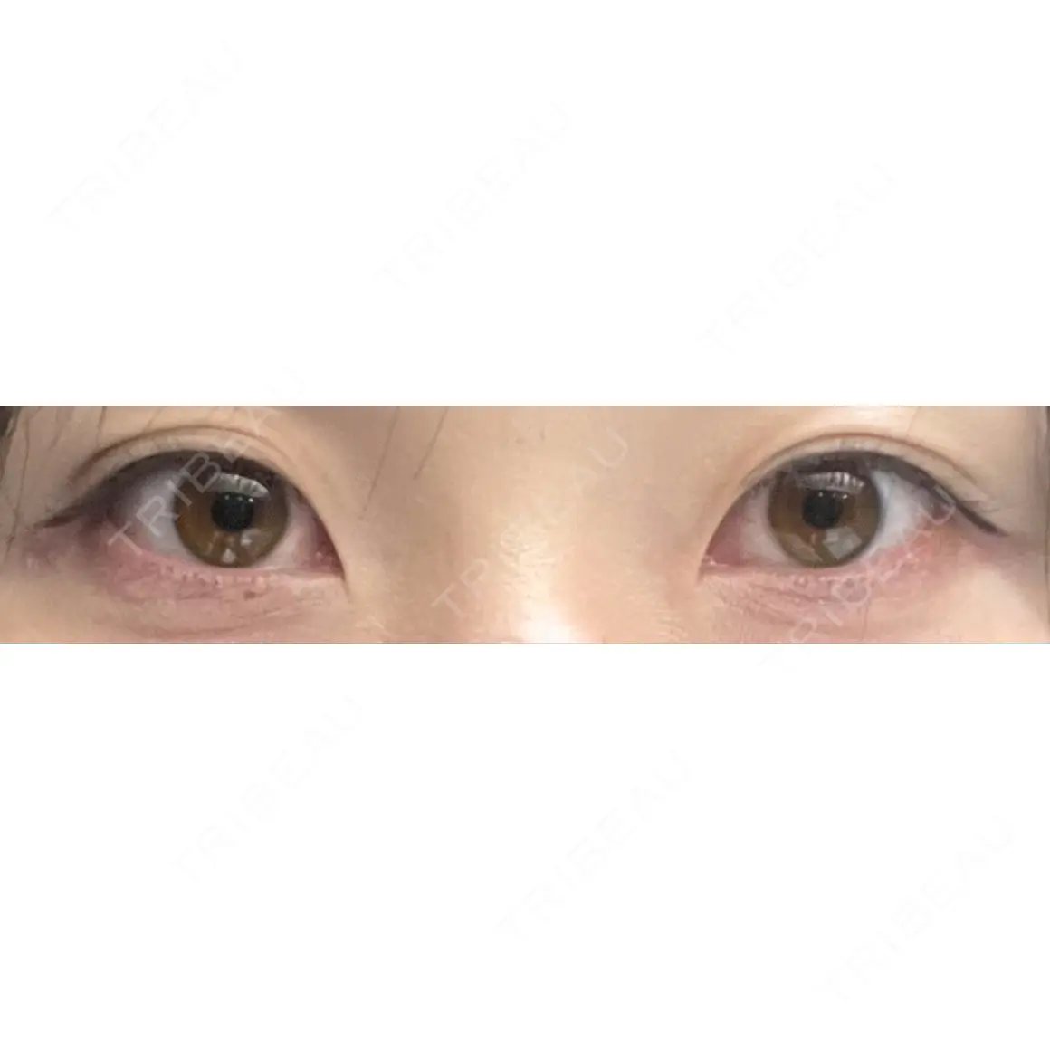 二重埋没 HAAB×DREAM BEAUTY CLINIC 大阪梅田院 AFTER