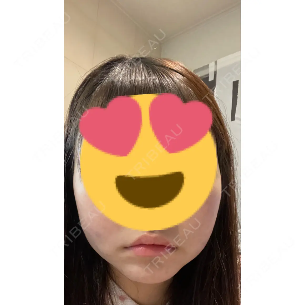 糸リフト / バッカルファット除去 / 脂肪吸引（顔） ブルームクリニック（BLOOM CLINIC） AFTER