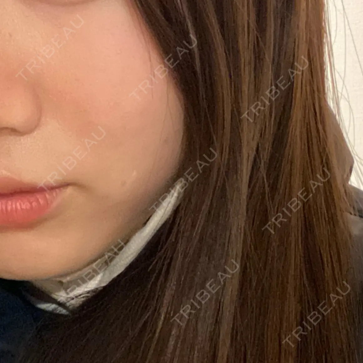 ピコレーザートーニング（美白・肝斑） / ピコフラクショナルレーザー（毛穴・ニキビ跡） SK新宿歌舞伎町美容外科・歯科 AFTER
