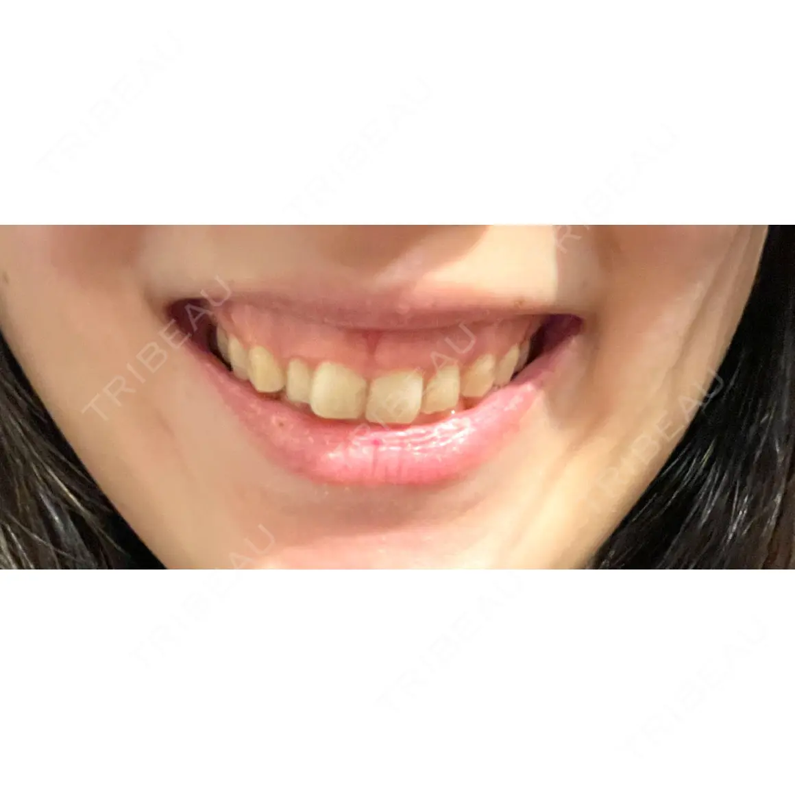 ガミースマイル手術 / ボトックス（ガミースマイル） 南青山矯正歯科 AFTER