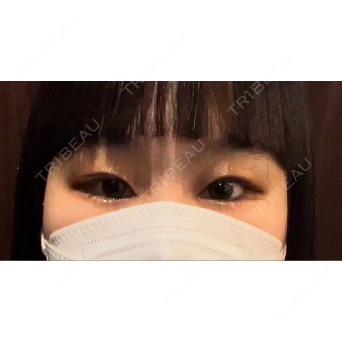 二重埋没 / 目頭切開 BELINDA CLINIC（ベリンダクリニック）新宿院 AFTER