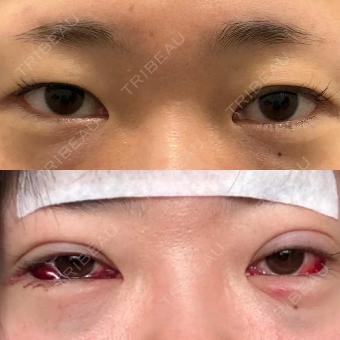 二重埋没 / 下まぶたの脂肪取り アリエル美容クリニック 郡山院 AFTER