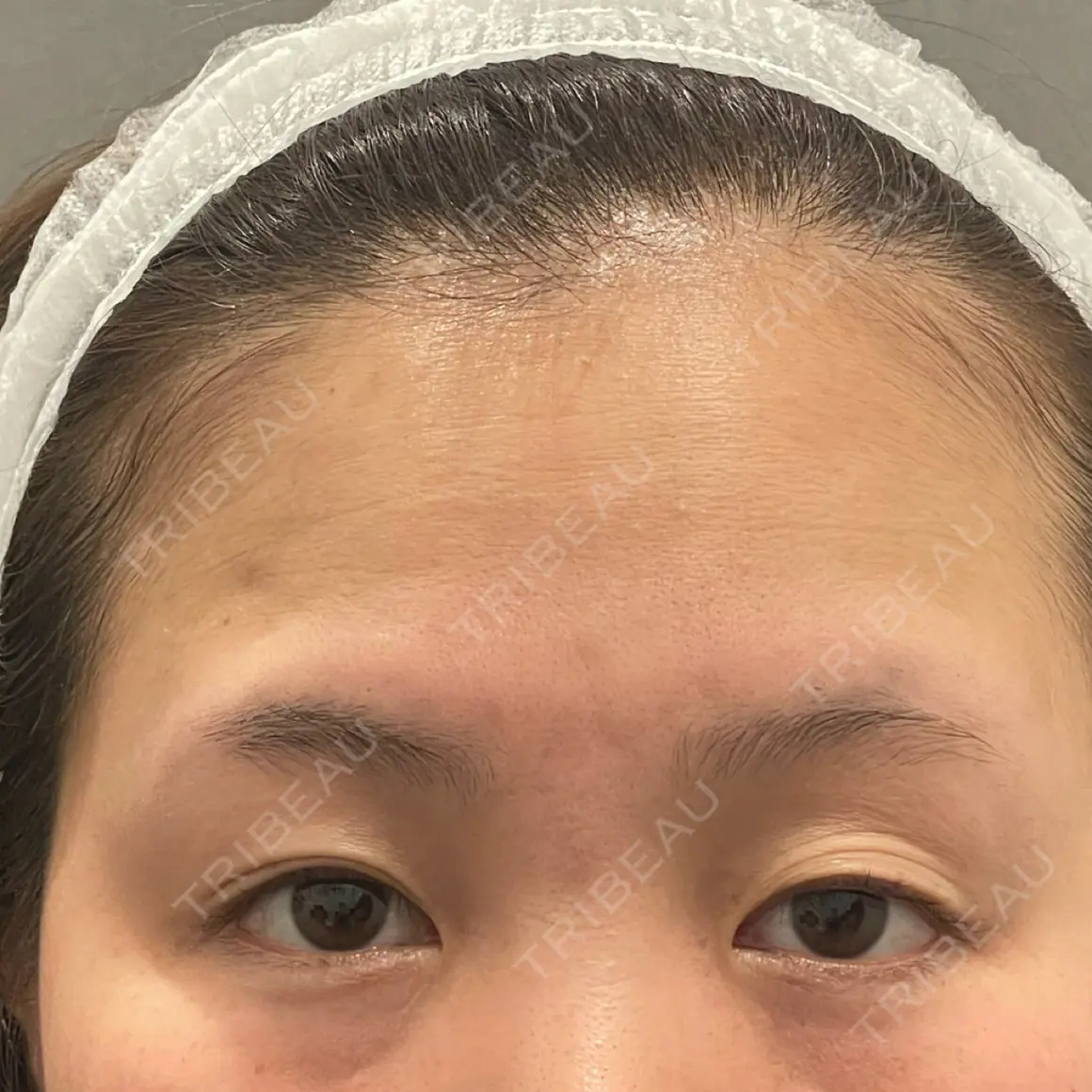 二重埋没 アリエル美容クリニック 郡山院 AFTER