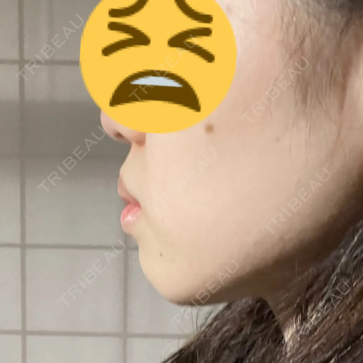 人中短縮 / ボトックス（あご） / ヒアルロン酸注入（あご） / ヒアルロン酸注入（唇） / ボトックス（口角） ルラ美容クリニック 名古屋本院 AFTER