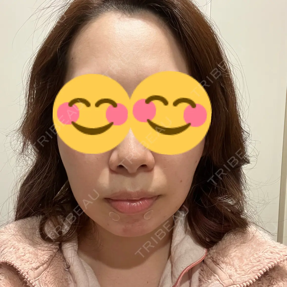 糸リフト / ジョールファット除去 ブルームクリニック（BLOOM CLINIC） AFTER