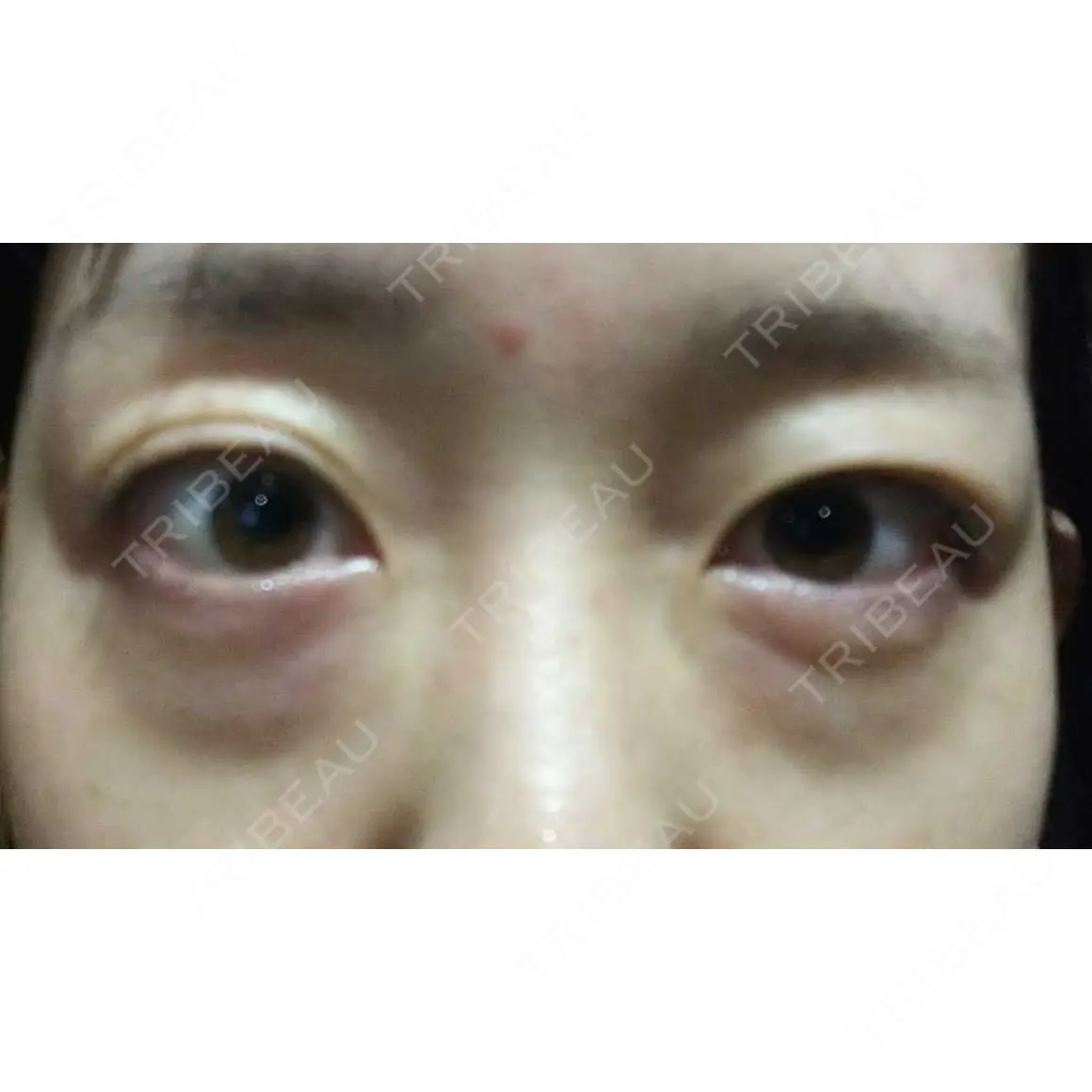 下まぶたたるみ取り / 下まぶたの脂肪取り 品川美容外科 渋谷院（※品川スキンクリニック提携） AFTER