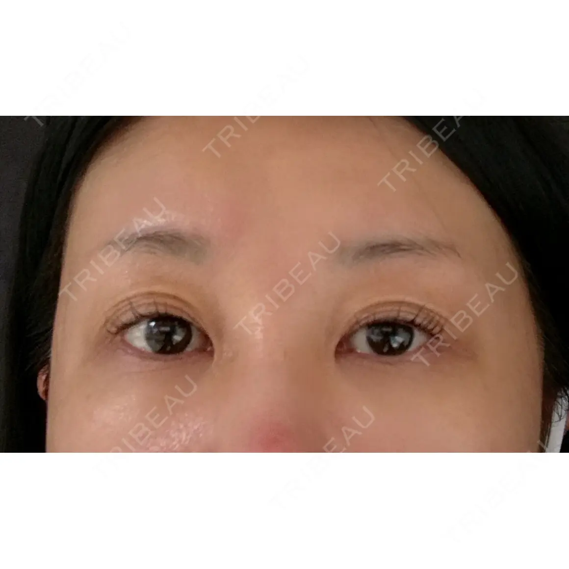 二重切開 / 眼瞼下垂（切開） / 上まぶたたるみ取り 四谷見附クリニック AFTER