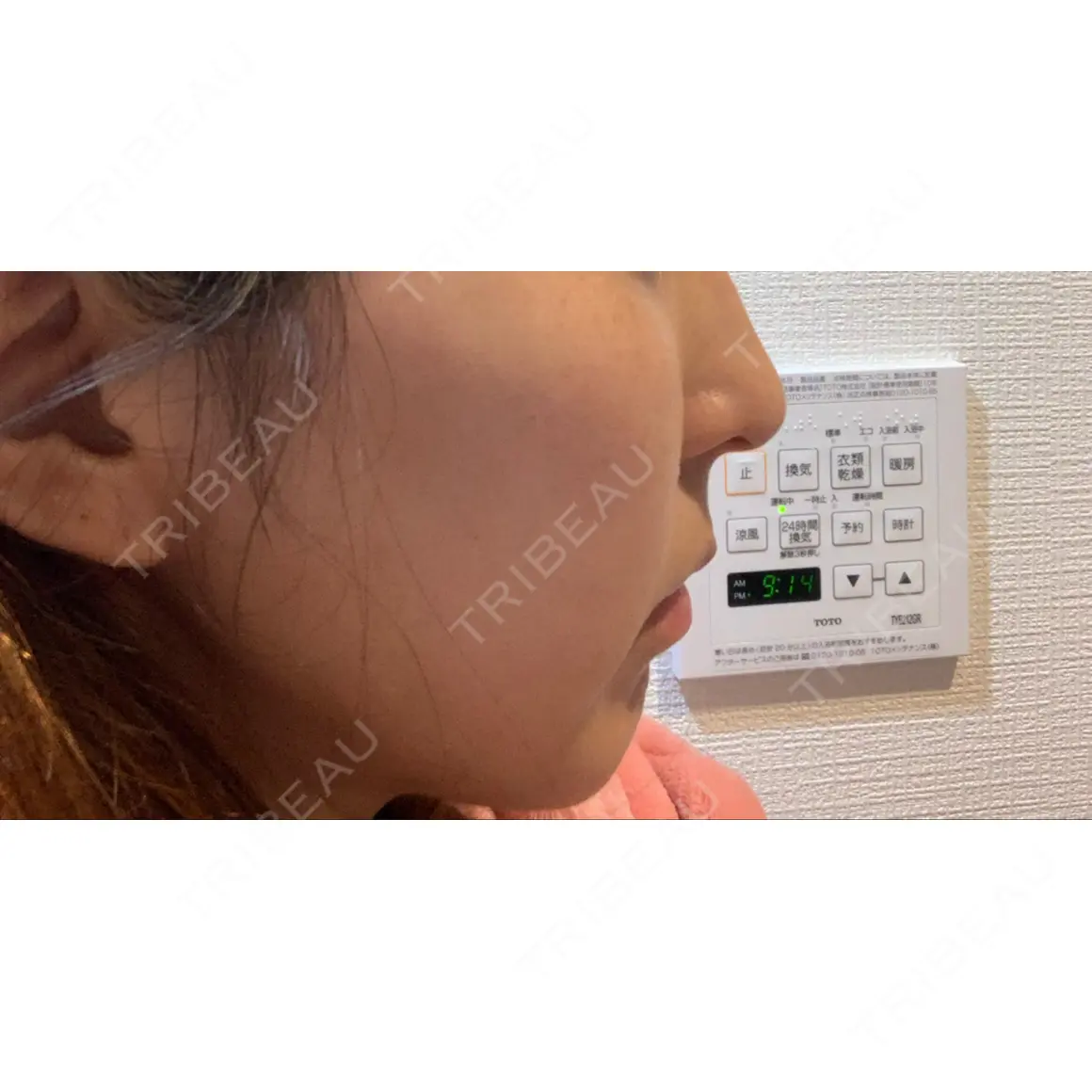 ヒアルロン酸注入（あご） 東京形成美容外科 船橋院 AFTER