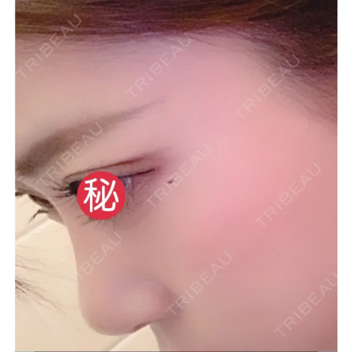 ヒアルロン酸注入（鼻） トアロード形成美容クリニック AFTER