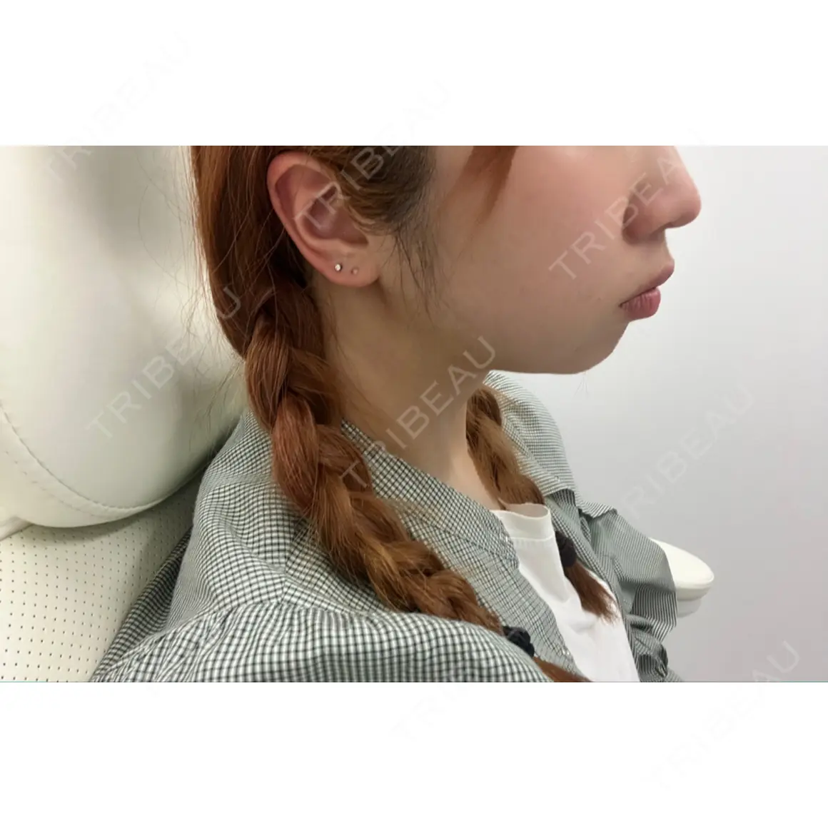 ヒアルロン酸注入（あご） / ボトックス（エラ・小顔） ASTRA BEAUTY CLINIC AFTER