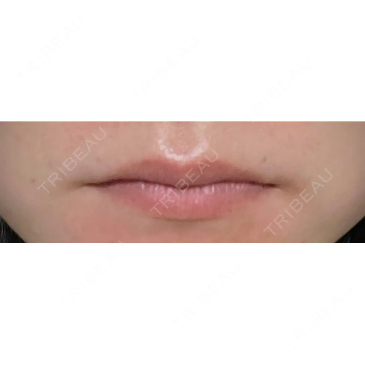 ヒアルロン酸注入（唇） / ボトックス（口角） ブルームクリニック（BLOOM CLINIC） AFTER