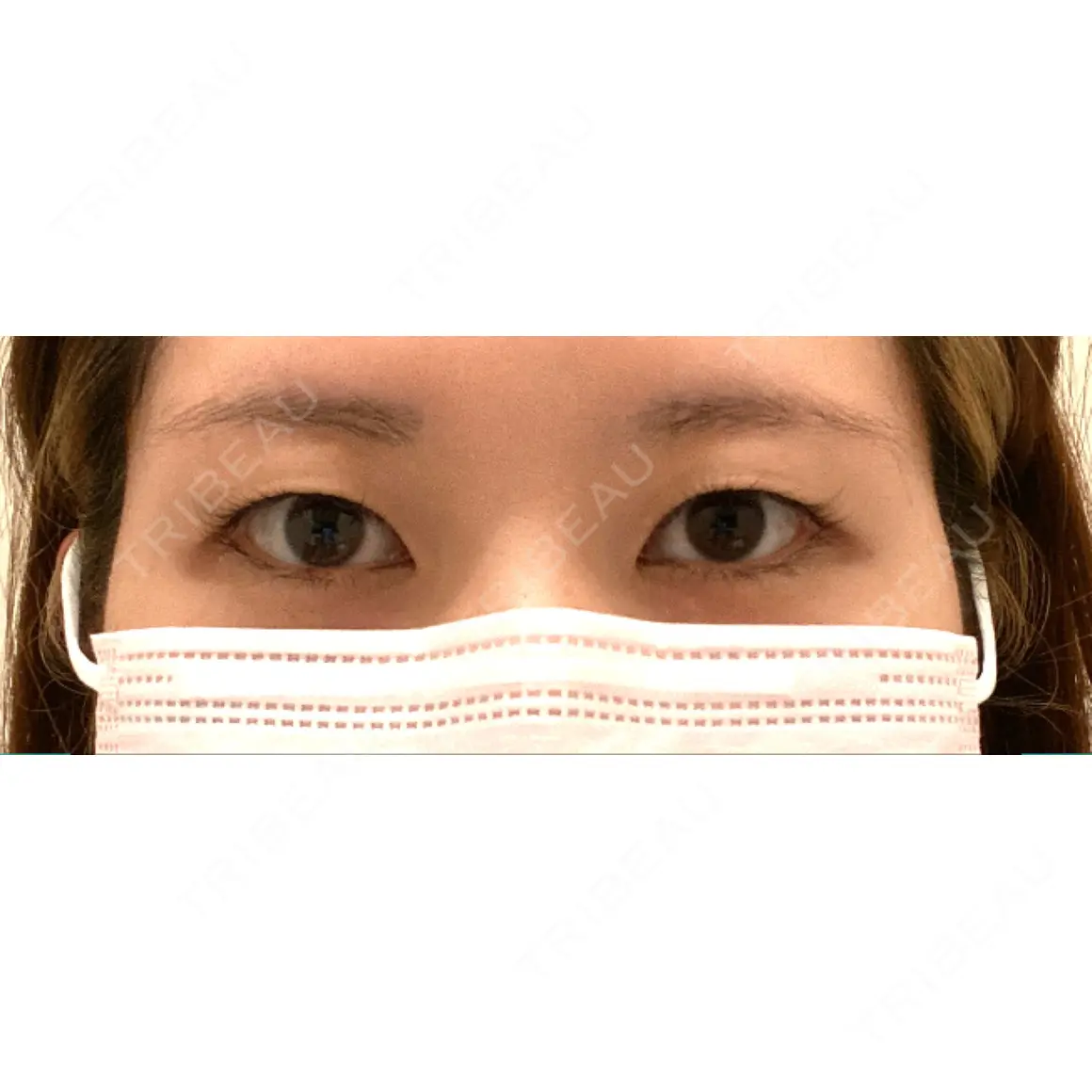 二重埋没 Olino美容外科・美容皮膚科 AFTER