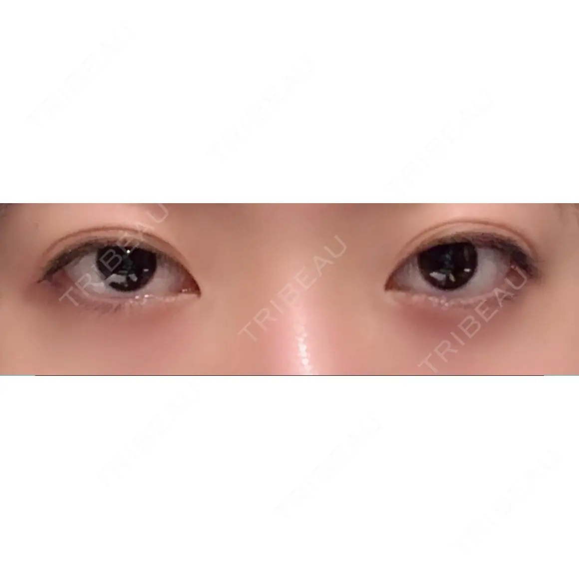 目頭切開 / 眼瞼下垂（切開） / 自然癒着法 プロミス整形外科 AFTER