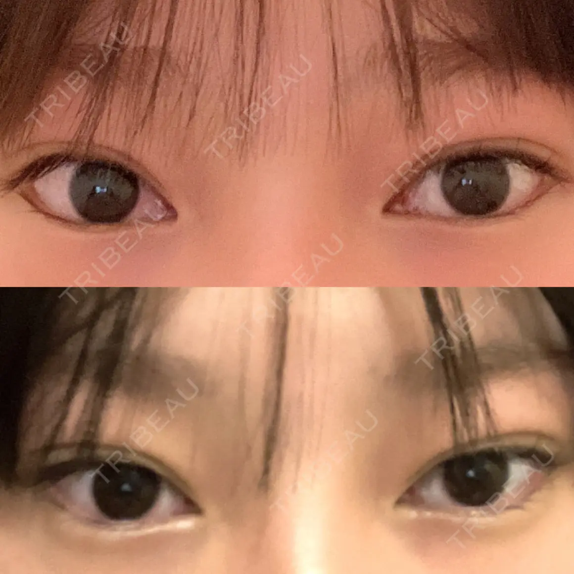 タレ目形成・グラマラスライン（切開） TIAM CLINIC GINZA AFTER