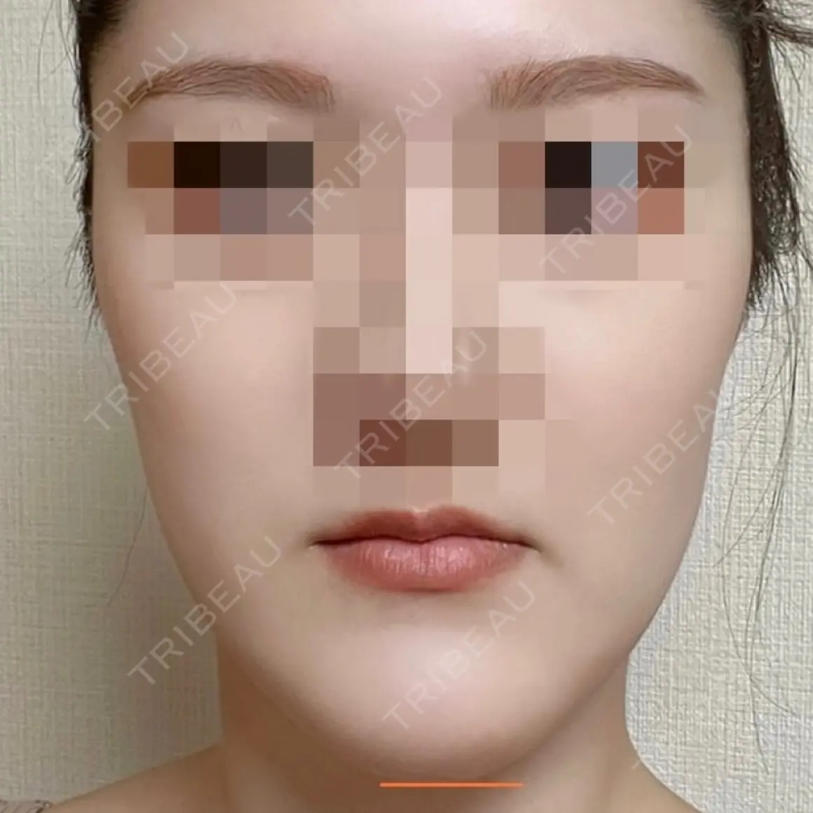 骨切り（あご） 銀座マイアミ美容外科 AFTER