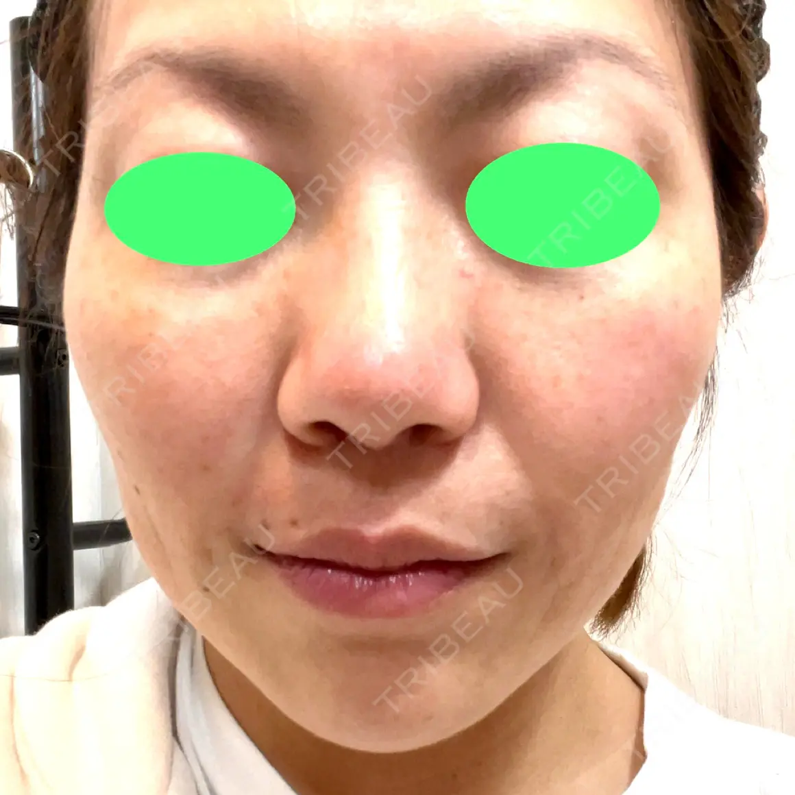 糸リフト / メーラーファット除去 TIAM CLINIC GINZA AFTER