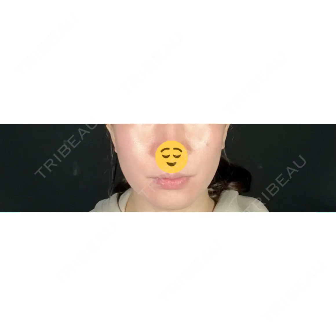 糸リフト / 脂肪吸引（顔） / ボトックス（エラ・小顔） TOTAL BEAUTY CLINIC AFTER