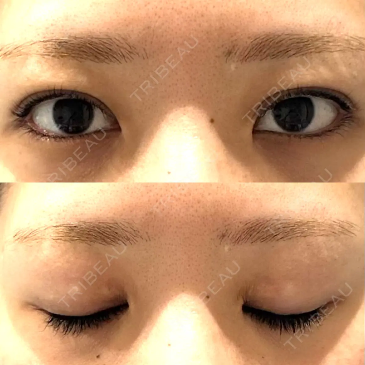 二重切開 / 目頭切開 / 眼瞼下垂（切開） Otus Clinic 【オータスクリニック】 AFTER