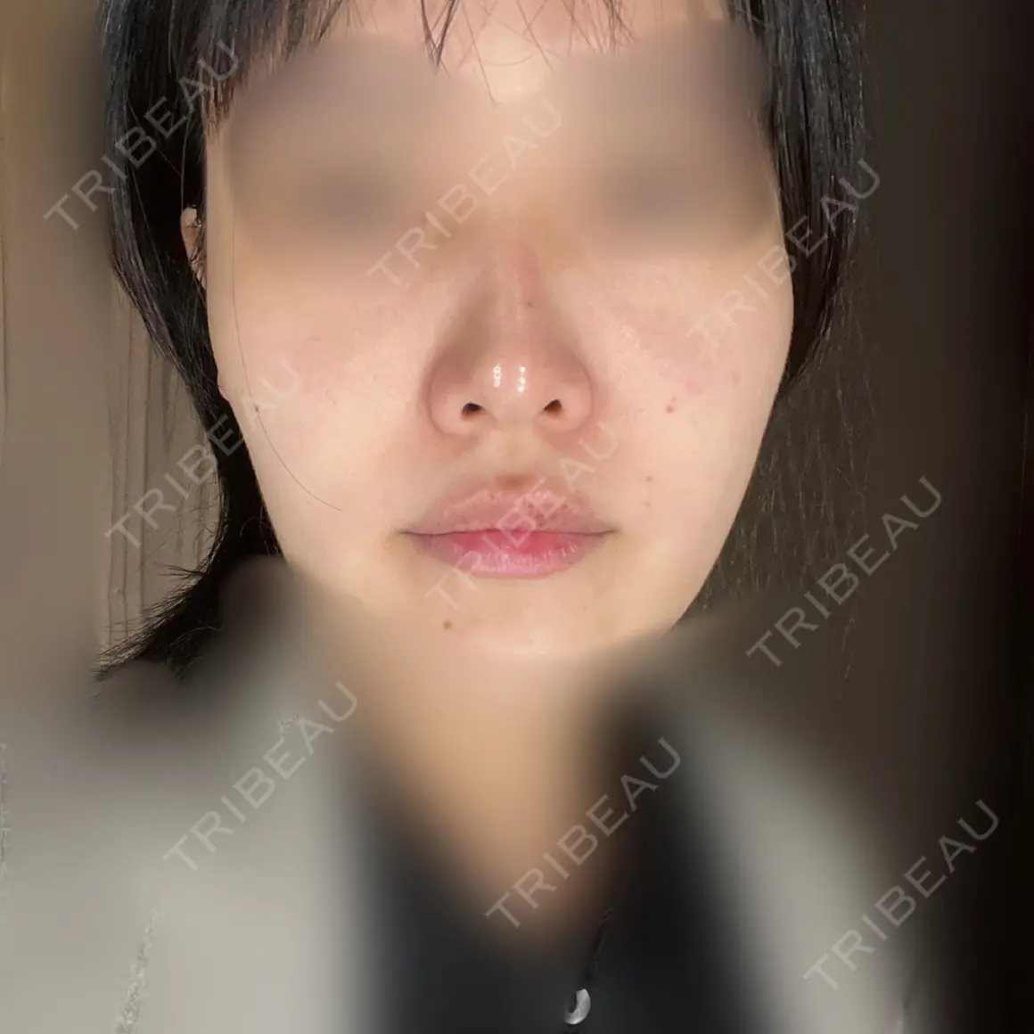 鼻尖形成（切開） / 軟骨移植 / 眉間プロテーゼ / 小鼻縮小（非切開） / 鼻柱下降・鼻唇角形成（猫手術） グローバルビューティークリニック 東京院 AFTER