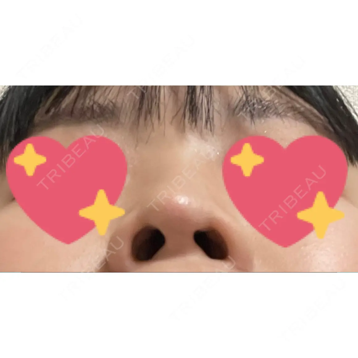 小鼻縮小（切開） Zetith Beauty Clinic 銀座院 AFTER