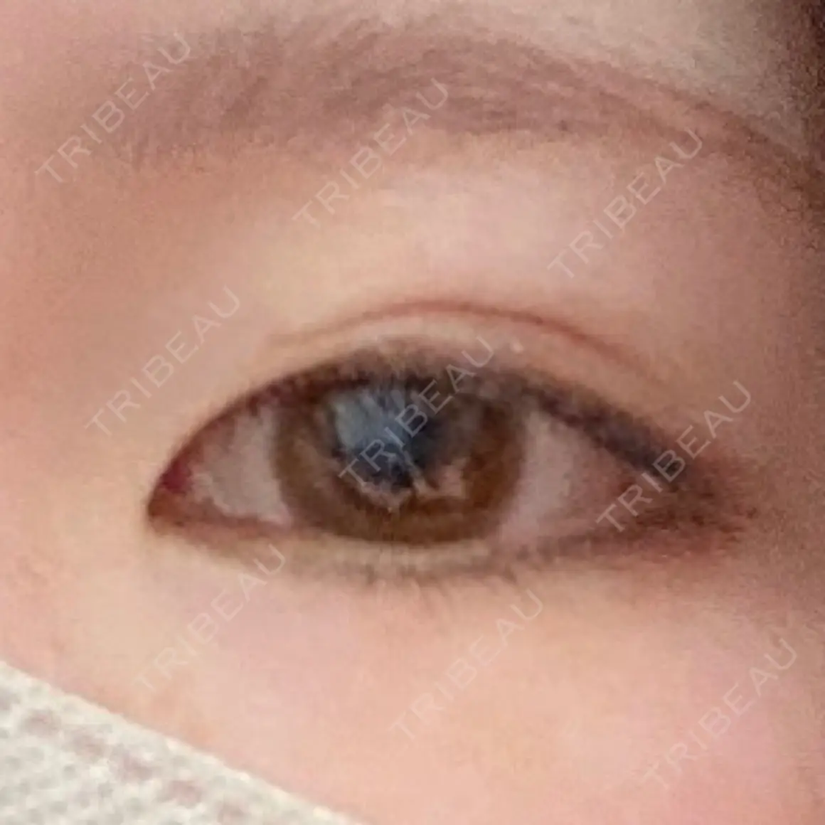 ヒアルロン酸注入（涙袋） 宇都宮竹内クリニック AFTER
