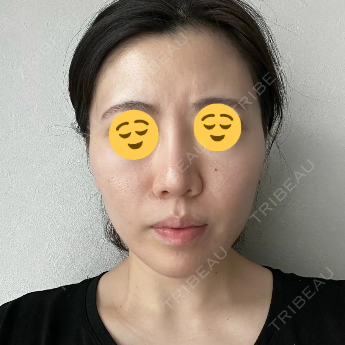 イオン導入 / ピーリング（ハリ・ツヤ） 湘南美容クリニック 静岡院 AFTER