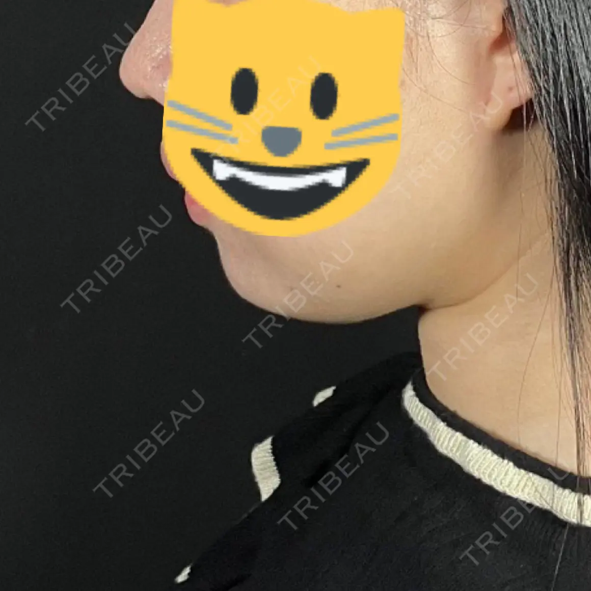 脂肪吸引（顔） TOTAL BEAUTY CLINIC AFTER
