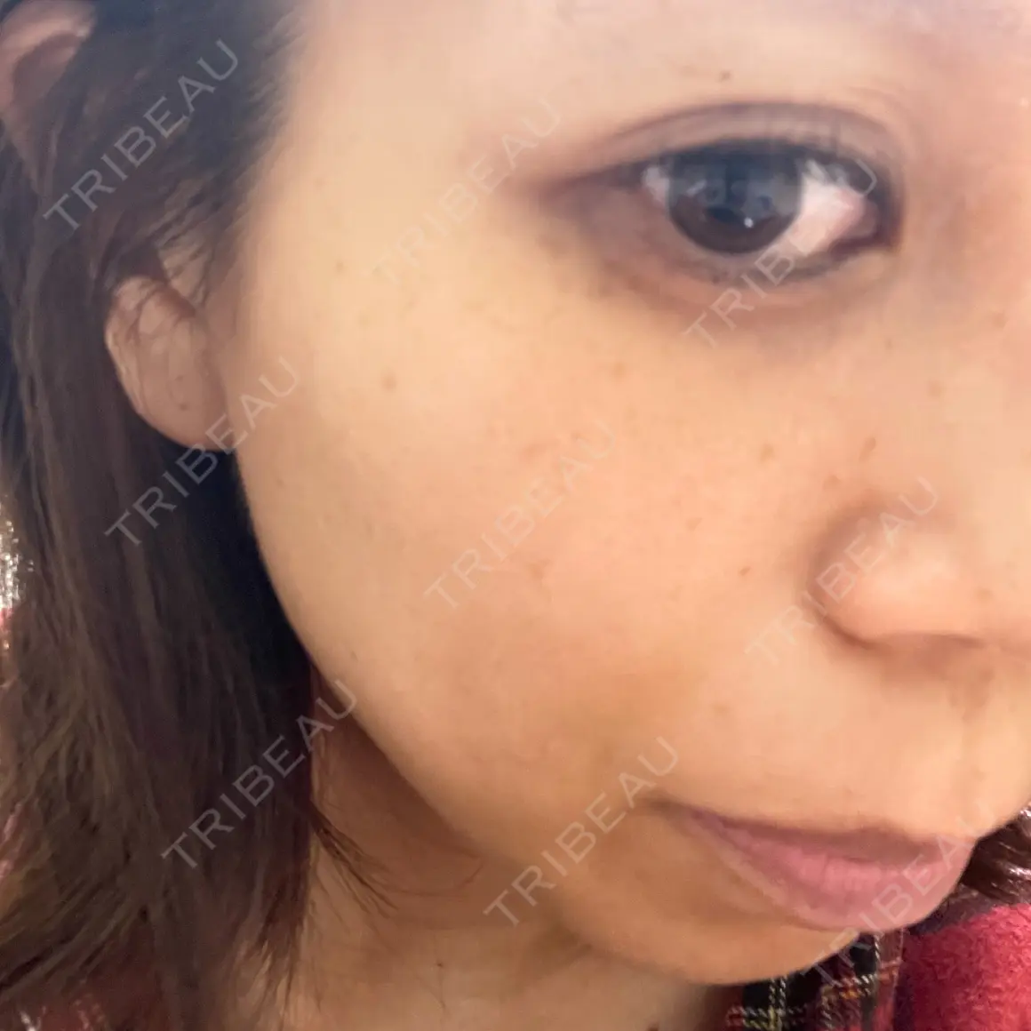 毛穴洗浄（ハイドラフェイシャルなど） / 光治療（フォトフェイシャルなど） まゆりなclinic 名古屋栄 AFTER