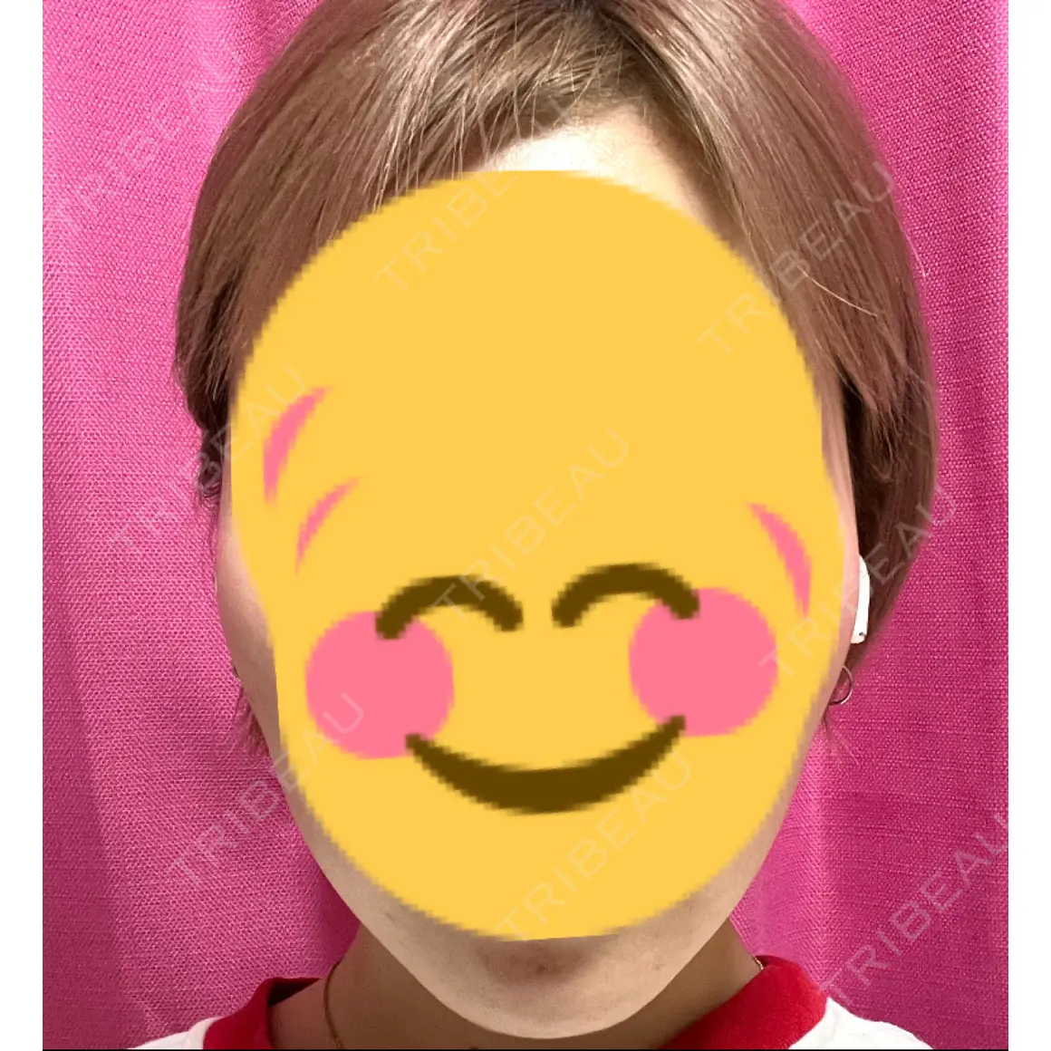 ボトックス（エラ・小顔） TCB東京中央美容外科 川越院 AFTER
