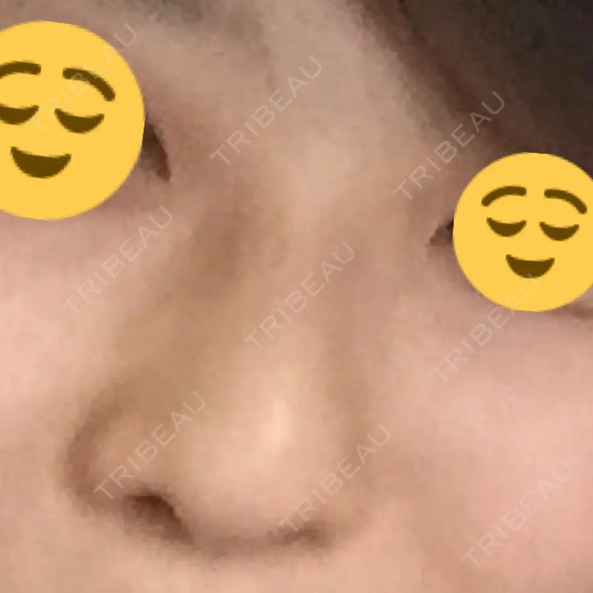 隆鼻術 / 鼻尖形成（切開） / 軟骨移植 / 骨切幅寄せ / 鼻尖縮小 / 真皮移植 ザ・プラス美容外科 AFTER