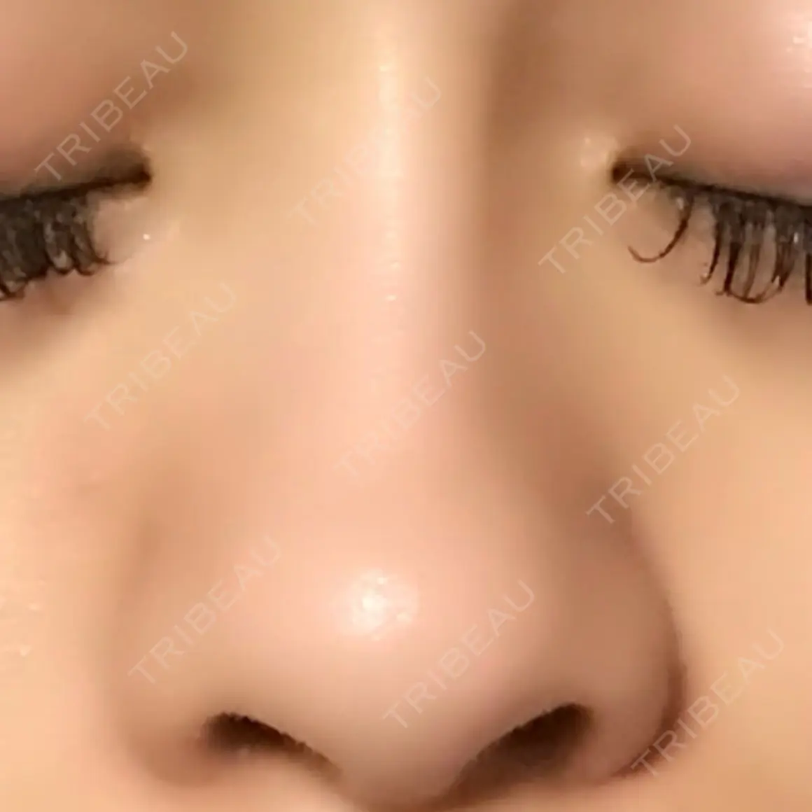 隆鼻術 / 鼻尖形成（切開） / 鼻中隔延長（切開） / 軟骨移植 / プロテーゼ除去 / 鼻修正 湘南美容クリニック 新宿本院 AFTER