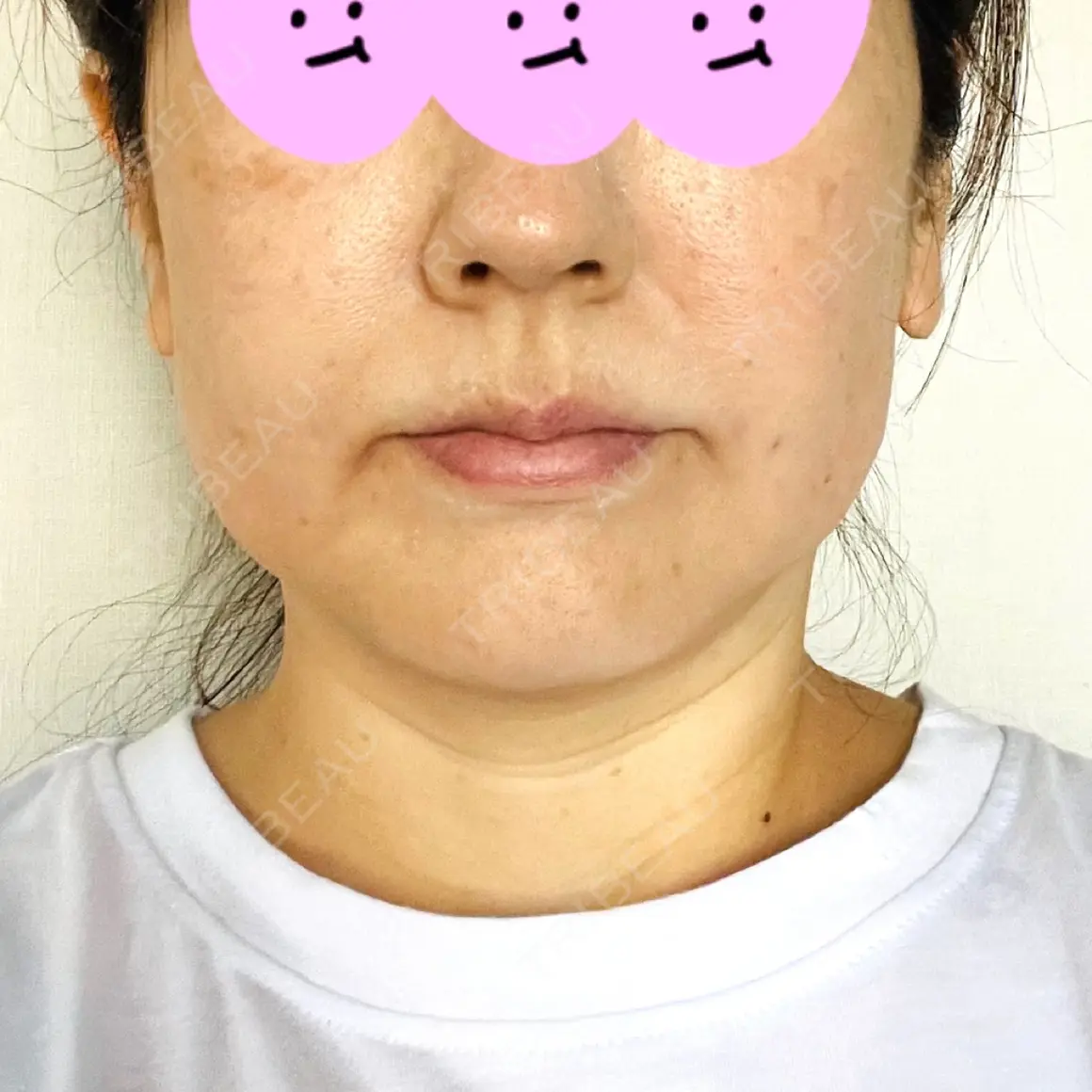 ボトックス（エラ・小顔） / ハイフ（顔） LOUIS CLINIC 二子玉川院【ルイクリニック】 AFTER