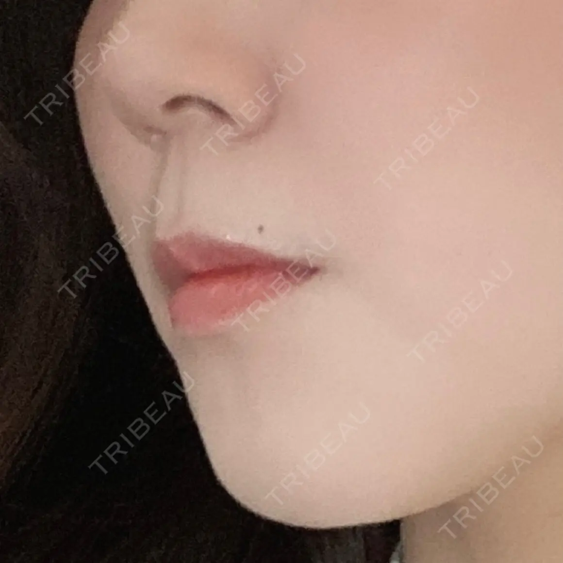 ボトックス（あご） / ボトックス（口角） / ボトックス（肩） / ボトックス（人中） EMMO FACE CLINIC 大宮院 AFTER