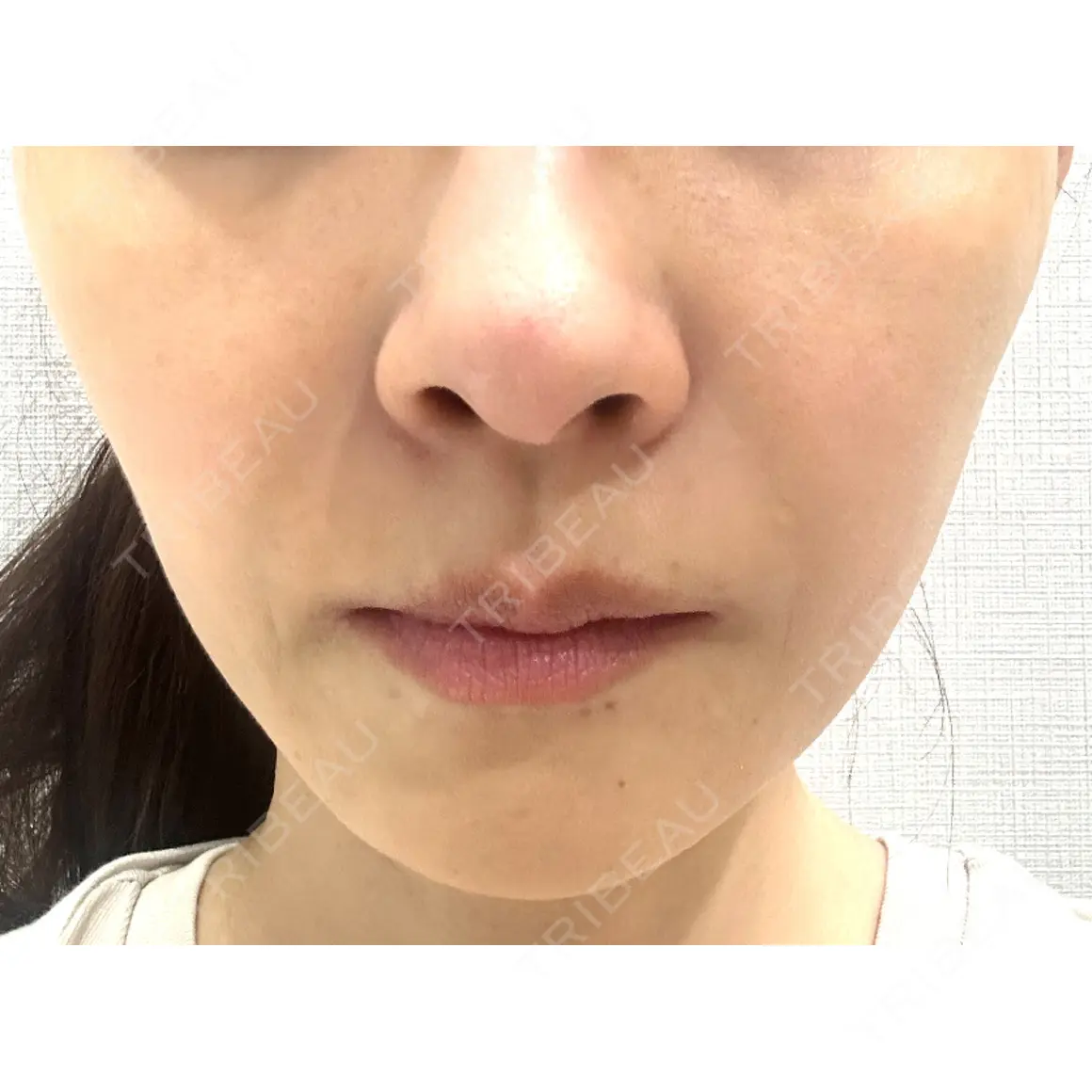 エレクトロポレーション / その他（肌） 湘南美容クリニック 静岡院 AFTER