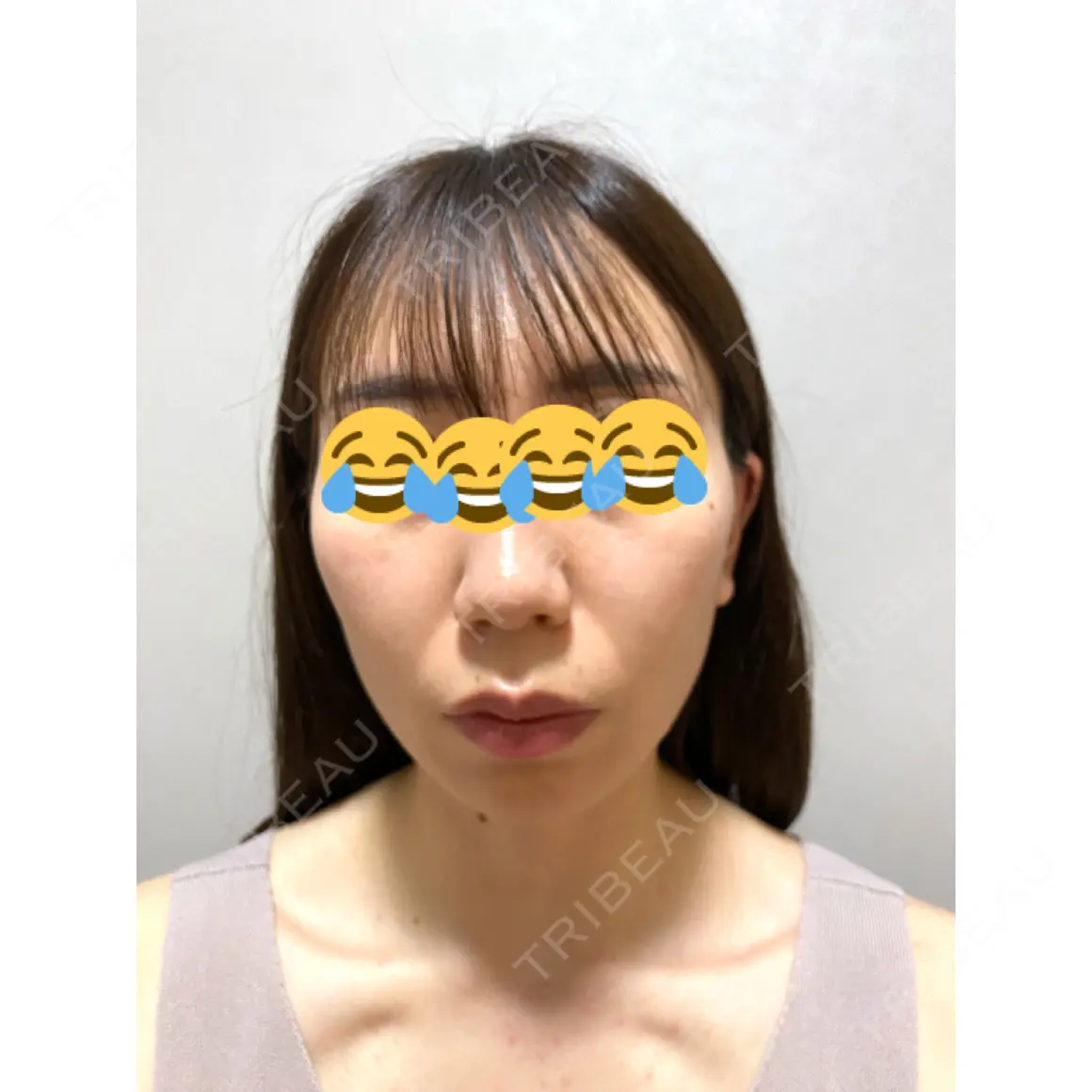 糸リフト 渋谷美容外科クリニック 渋谷院 AFTER