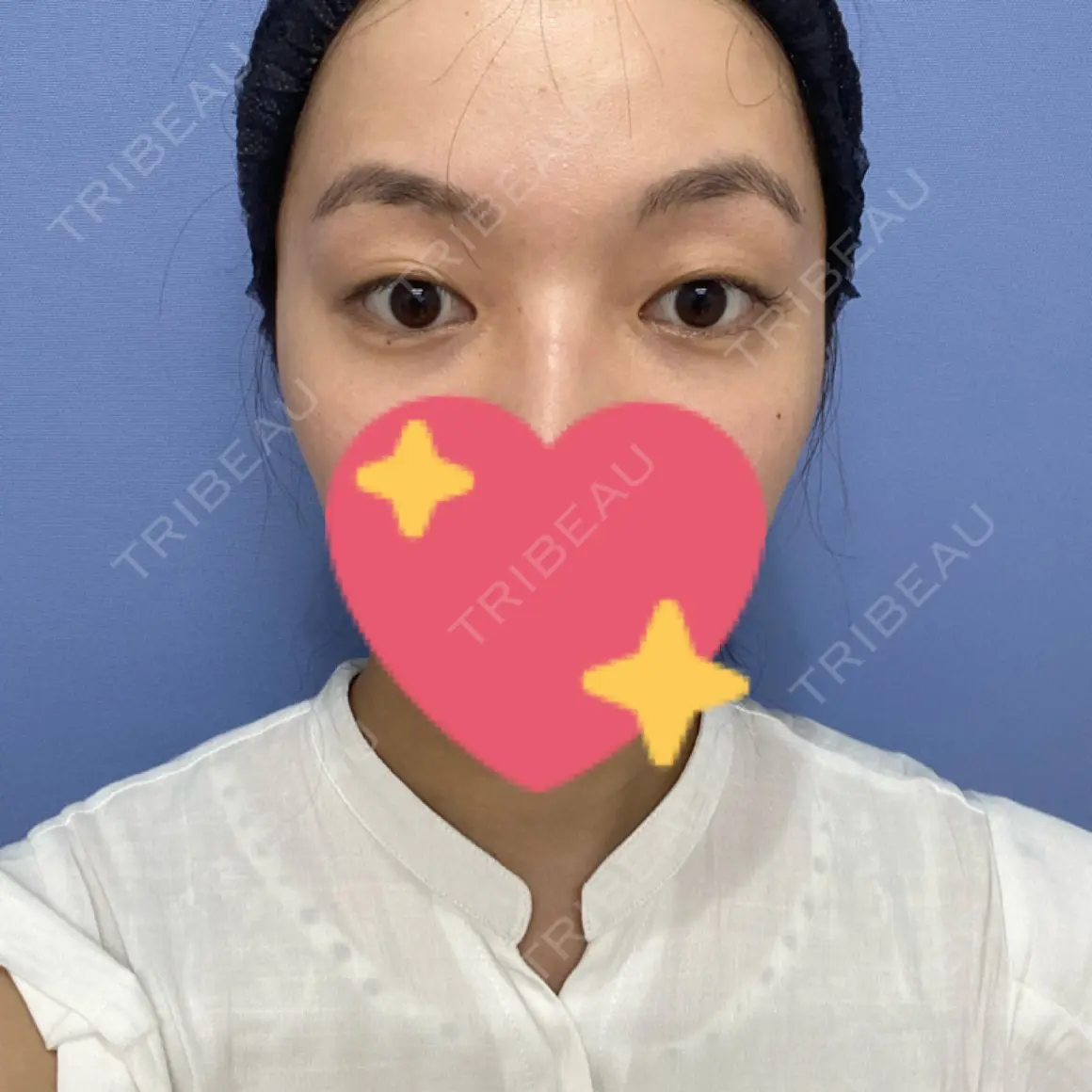 二重埋没 湘南美容クリニック 西葛西院 AFTER
