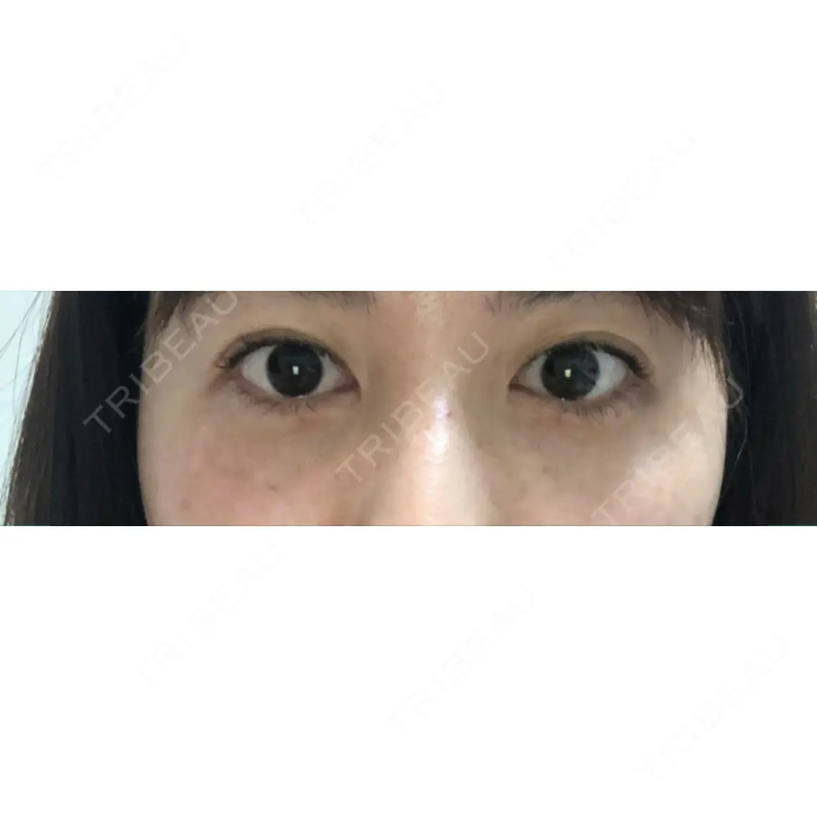 二重埋没 お茶の水美容形成クリニック AFTER