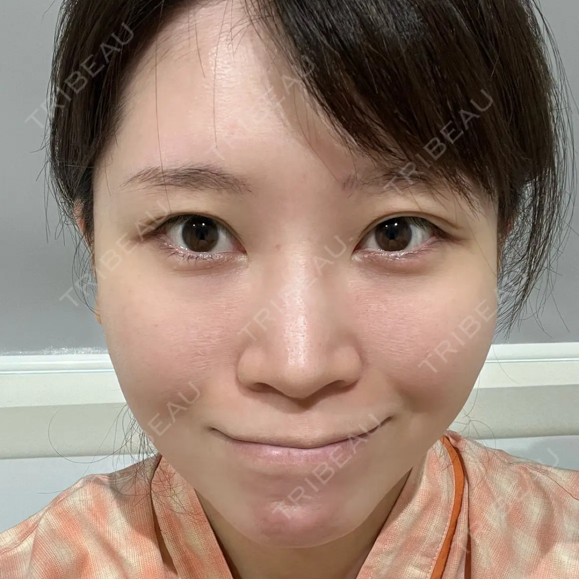 糸リフト / クマ治療 / 眉下切開 / メーラーファット除去 / 脂肪注入（目の下） Otus Clinic 【オータスクリニック】 AFTER