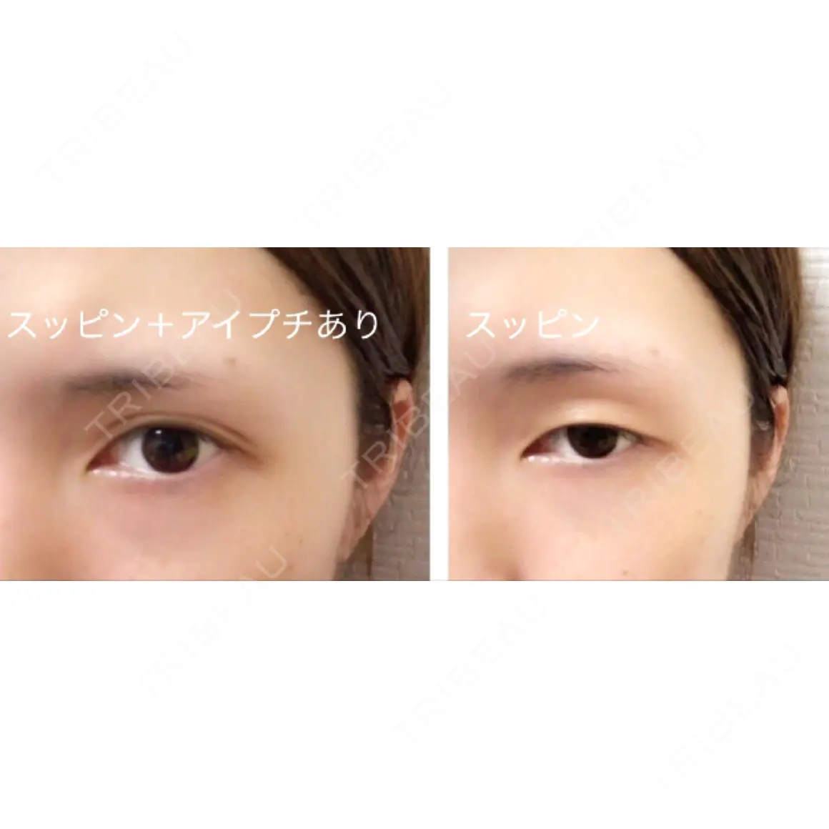 二重埋没 大阪梅田中央クリニック美容外科 AFTER